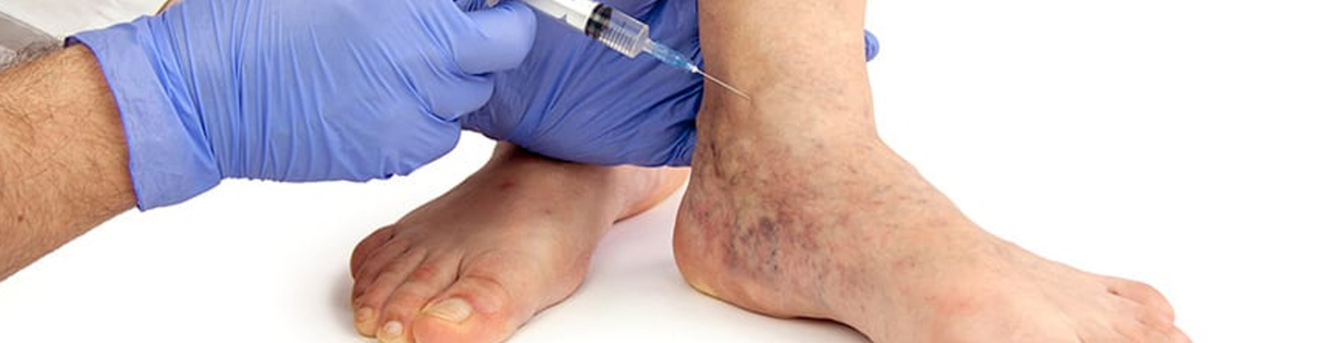 The Best Treatments For Varicose Veins
