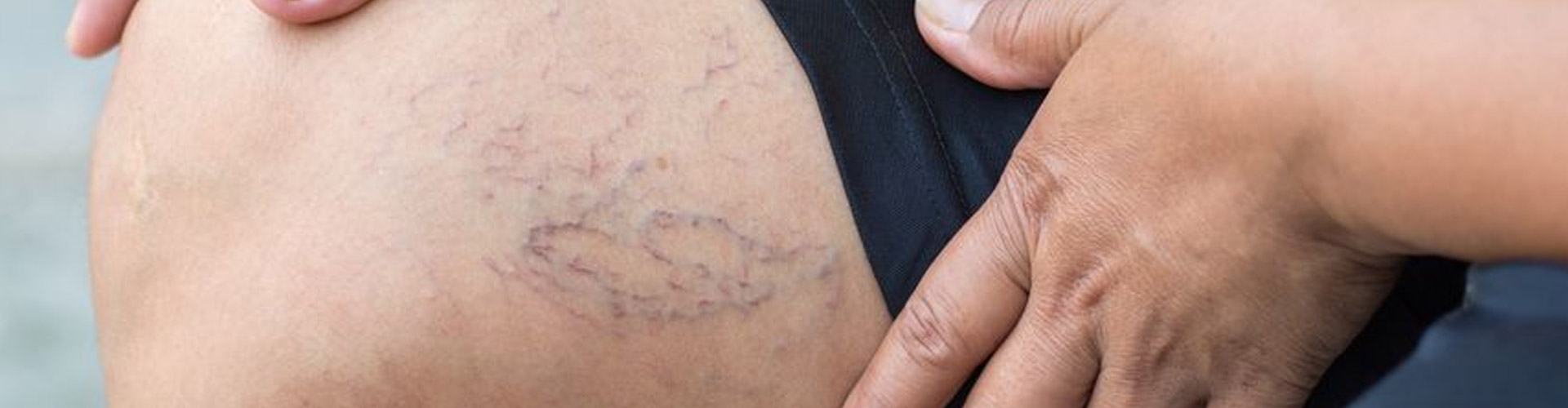 Varicose Veins vs. Spider Veins: What's the Difference?
