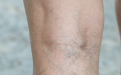 When to Be Concerned About Varicose Veins