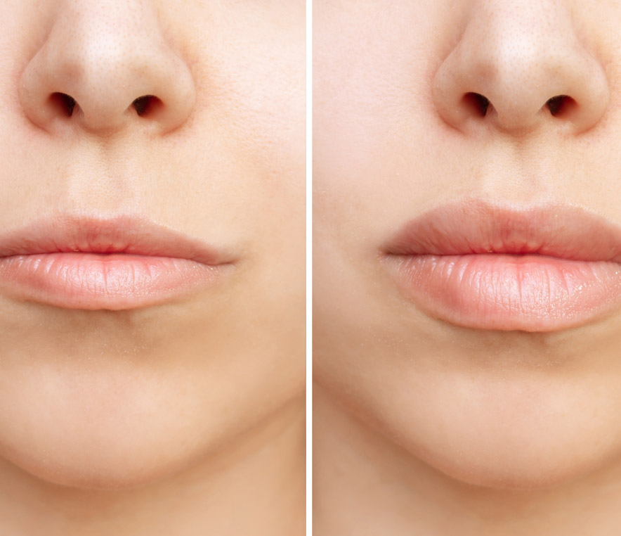 We offer multiple lip procedures to achieve the best results.