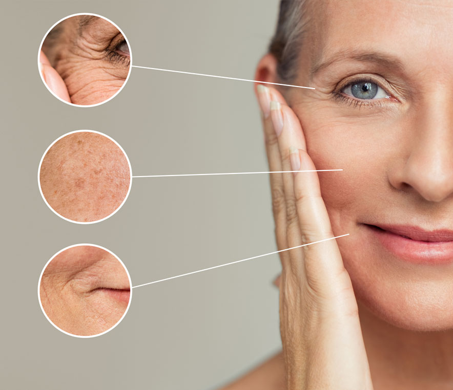 Who is RF Microneedling For?