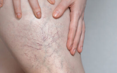 What happens if varicose veins go untreated?