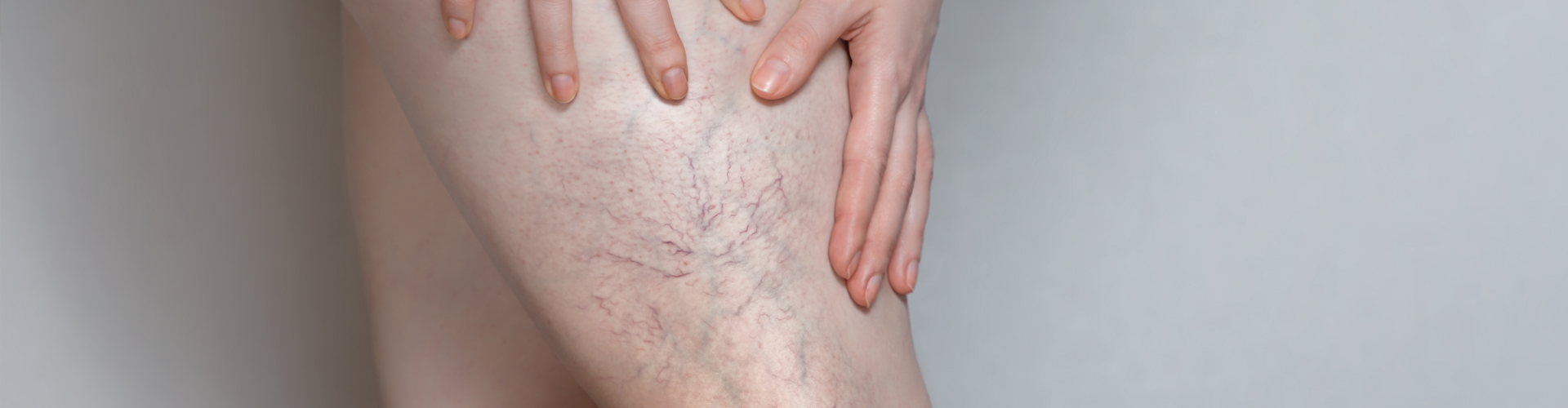What happens if Varicose Veins go untreated?