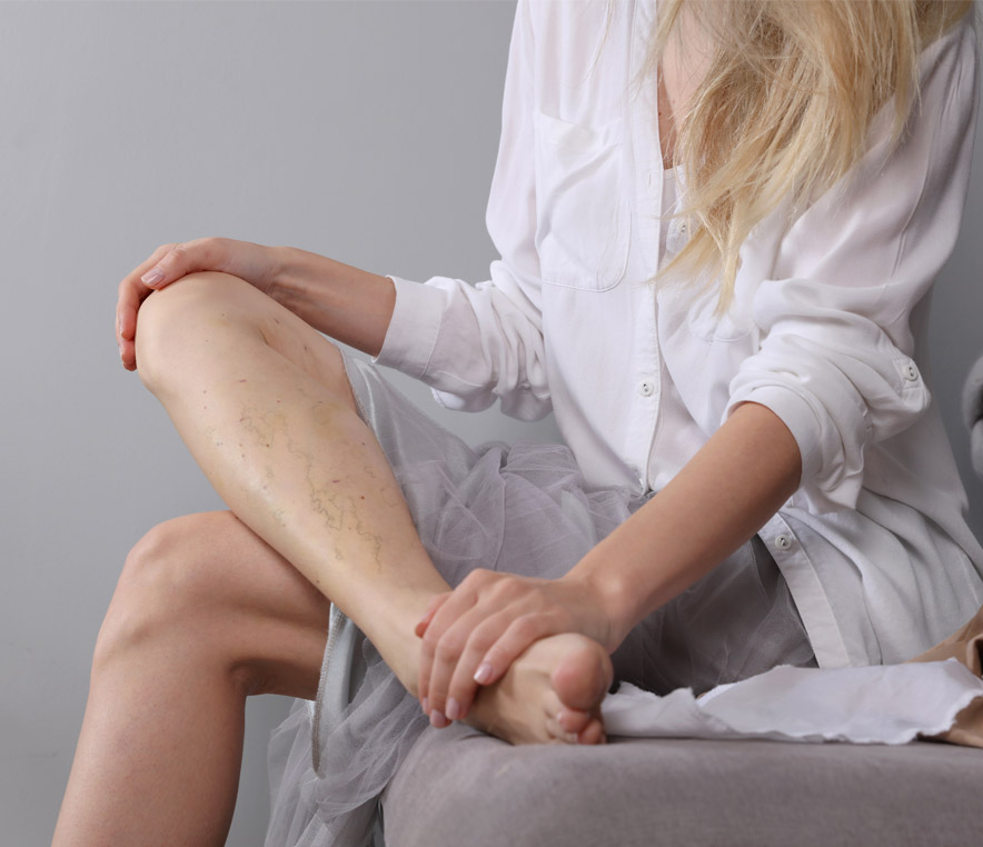 High-Quality Treatments for Spider Vein Issues