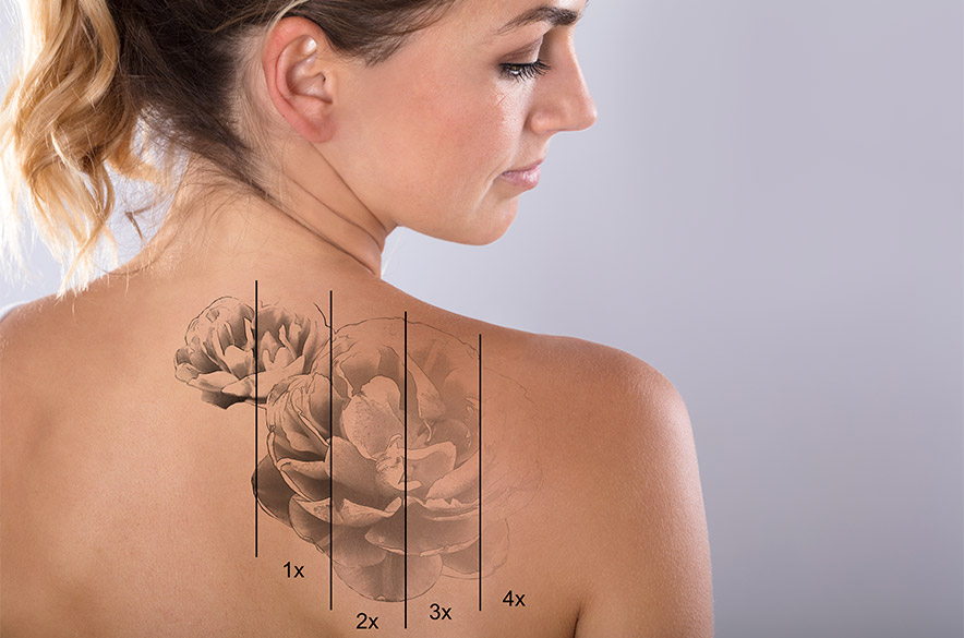 Our Tattoo Treatment Process