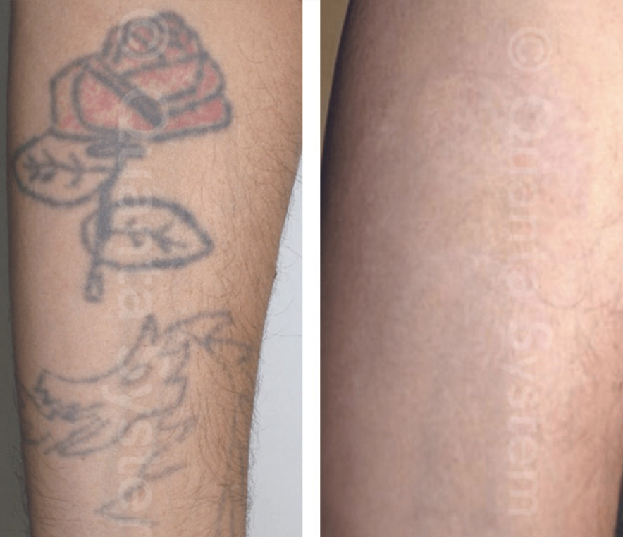 What to expect during laser tattoo treatment